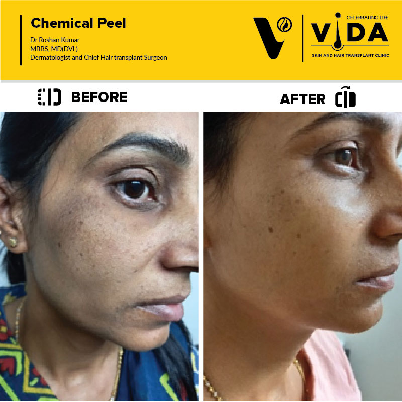 Chemical peel