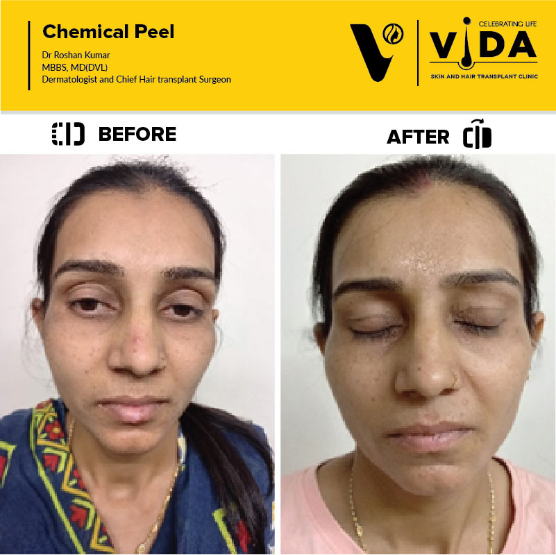 Chemical peel