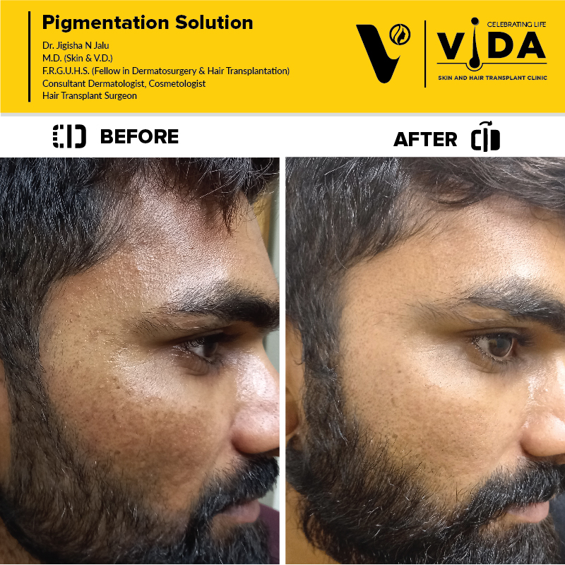 Pigmentation Solution