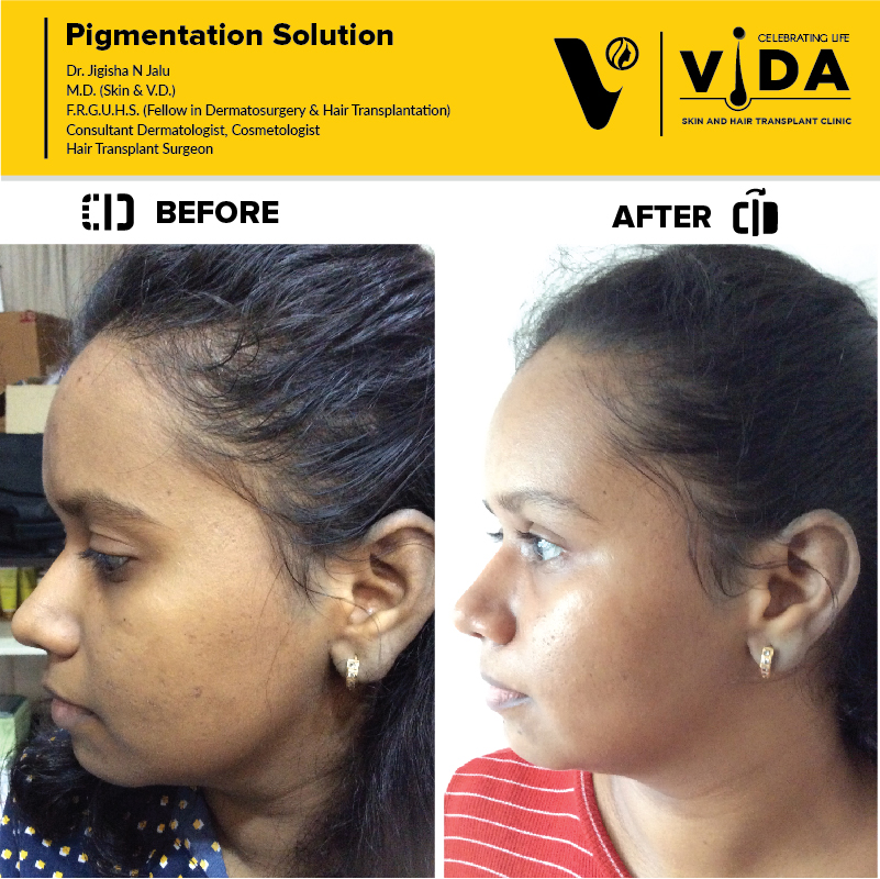 Pigmentation Solution