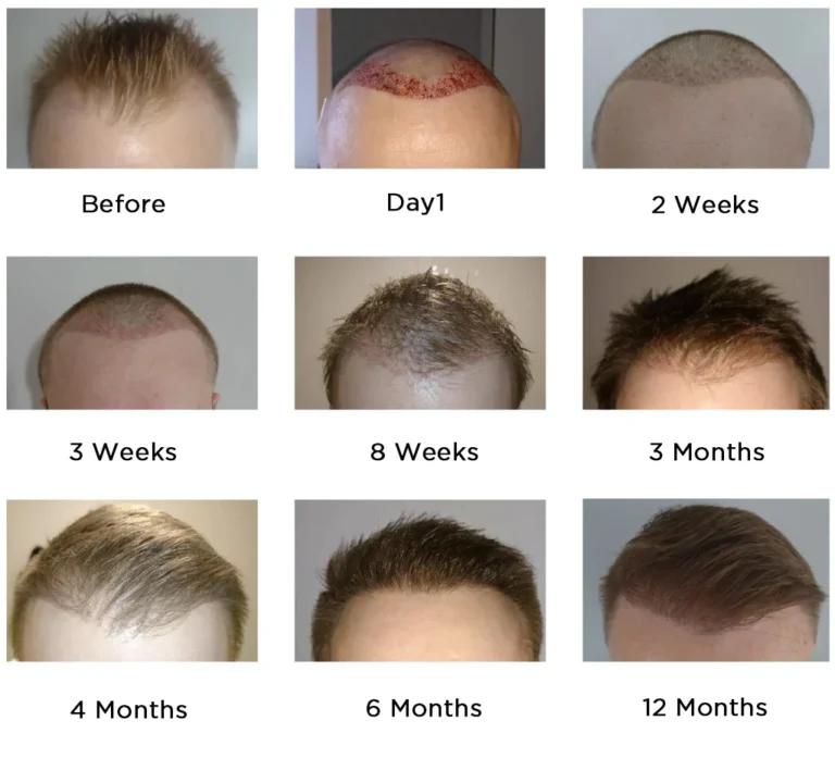 Hair Transplantation