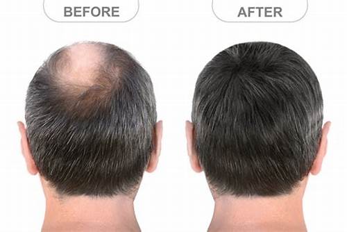 Before and After Hair Transplantation