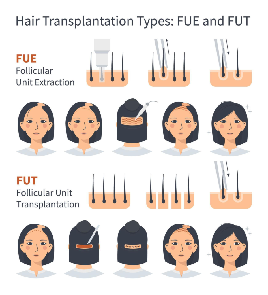 Female Hair Transplantation