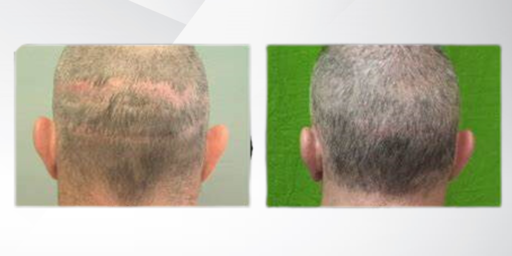 Revision Hair Transplant